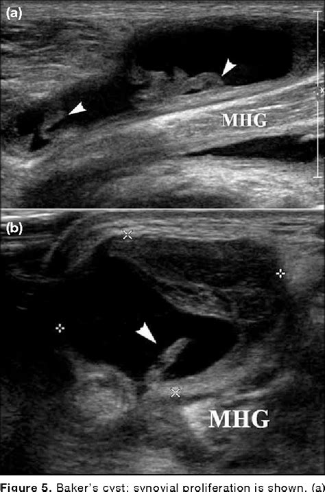 Figure 5 From Sonography Of Bakers Cyst Popliteal Cyst The Typical