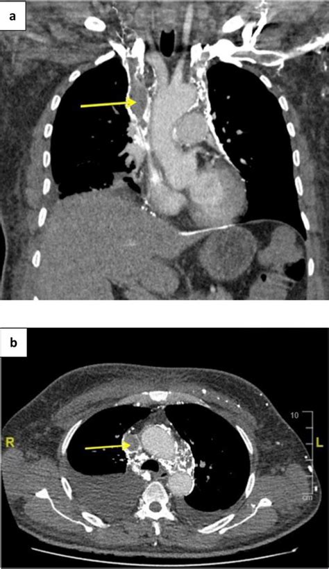 An Unusual Case Of Superior Vena Cava Syndrome Rcp Journals