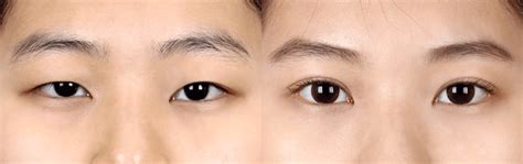 Double Eyelid Surgery In Korea Costs Before And After Recovery Mina