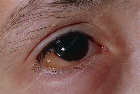 Inflamed Eye Due To An Allergy Response To Pollen Stock Image M320