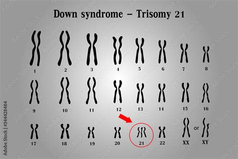 Vecteur Stock Karyotype Of Down Syndrome Ds Or Dns Also Known As Trisomy 21 Is A Genetic