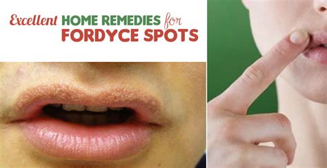 11 Excellent Home Remedies For Fordyce Spots