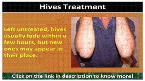 Best Treatment For Hives Youtube
