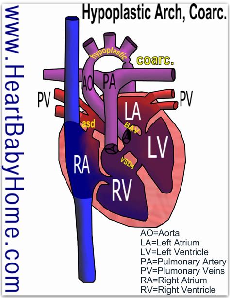 50 Hypoplastic Arch Coarc Bicuspid Heart Defect Hypopla Flickr