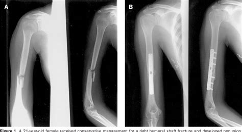 Figure 1 From Treatment Of Nonunion Of Humeral Shaft Fracture With