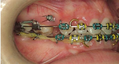 Mini Implant Anchors North Sydney Orthodontics