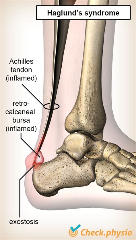 Haglund S Exostosis Physio Check