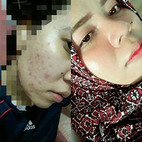 Seakan berjuang mengatasi jerawat saja belum cukup berat, luka parut dan eritema pasca inflamasi yang diakibatkannya pun mungkin masih tersisa salah satu produk kecantikan yang patut anda coba adalah bio oil. Gadis Ini Kongsi Cara Paling Berkesan Bagi Hilangkan Parut ...