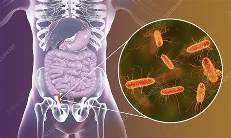 Appendicitis Illustration Stock Image F0223271 Science Photo