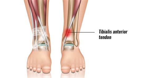 Tibialis Anterior Tendonitis Overuse Injury Inflammation Injury My