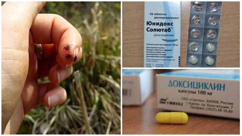 How To Take Doxycycline With A Tick Bite