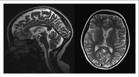 Brain Magnetic Resonance Imaging Mri Of The Patient Performed At The Download Scientific