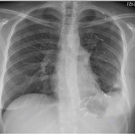 Frontal Chest Radiograph 2 Months After Resection With Near Complete