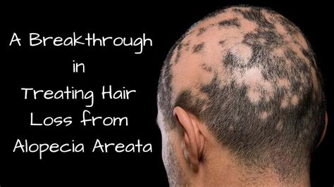 A Breakthrough In Treating Hair Loss From Alopecia Areata Mom At Work