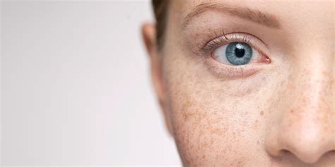 The Truth About Freckles Difference Between Freckles Melasma And