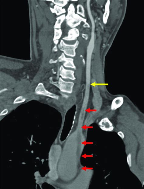 Contrast Enhanced Sagittal Oblique View Of The Thoracic Aorta Showing