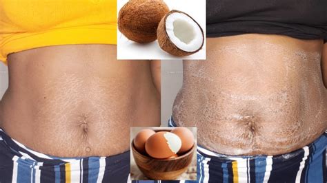 REMOVE Your STRETCH MARKS In 3days With Just This Remedy YouTube