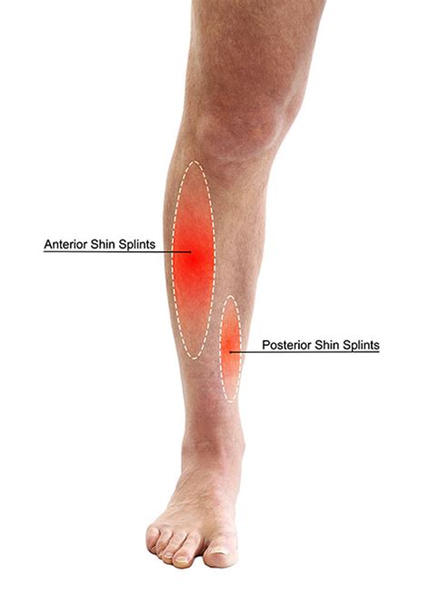 Shin Splints Causes Symptoms Treatment Prevention Str