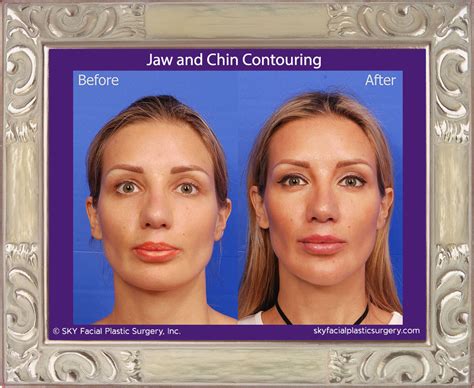 Facial Contouring And Implants San Diego — Sky Facial Plastic Surgery