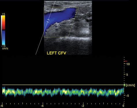 Venous Doppler Sonography Of The Extremities A Window To OFF