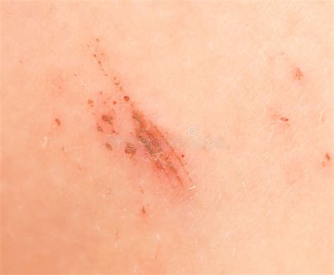 A Wound On The Skin Stock Image Image Of Pain Healthcare 89614255