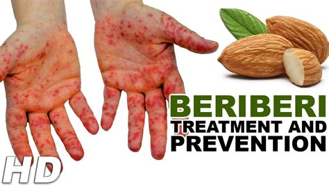 Beriberi Treatment And Preventionways To Prevent Beriberi Disease