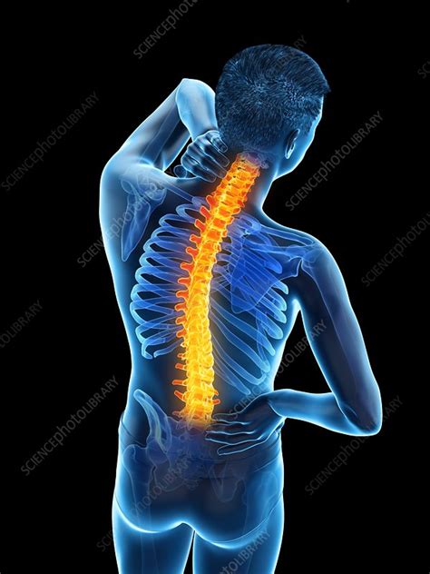 Back Pain Conceptual Illustration Stock Image F0257768 Science