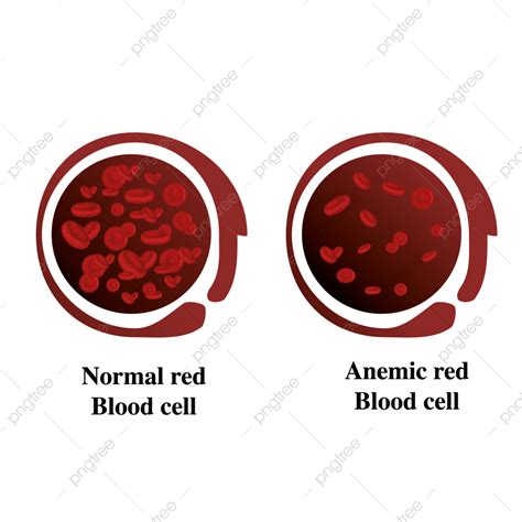 Anemia Hierro Glóbulos Rojos Medical Vector Ilustración Png Anemia