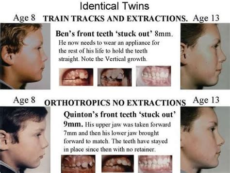 Eric Davis Dental Overbite Understanding The Overbite And How To