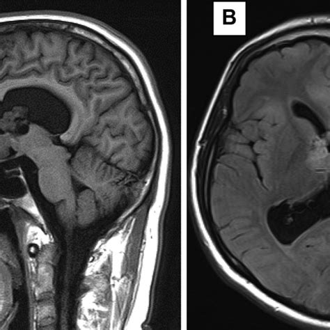 Brain Mri Findings Of Tuberous Sclerosis Complex A Sagittal View Of