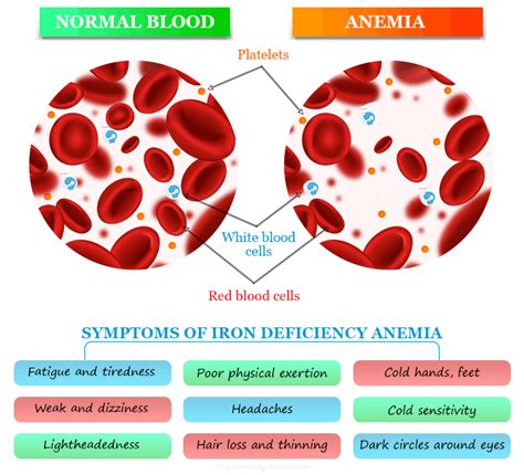 Iron Deficiency Anemia Causes Symptoms Treatment