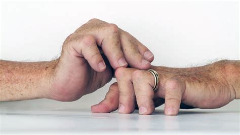 New ACR/EULAR Guideline Expands RA Remission Definition | MedPage Today