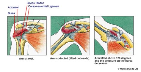 Shoulder Bursitis Injury Treatment Guide