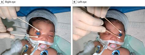 Ophthalmic Manifestations Of Congenital Zika Syndrome Congenital Defects Jama Ophthalmology