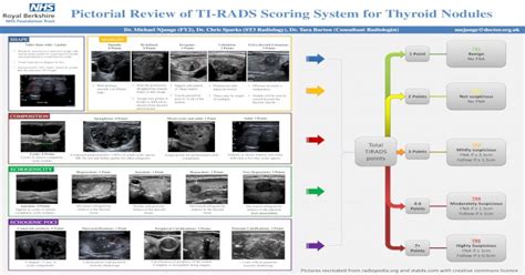 Pictorial Review Of Ti Rads Scoring System For Thyroid Nodules