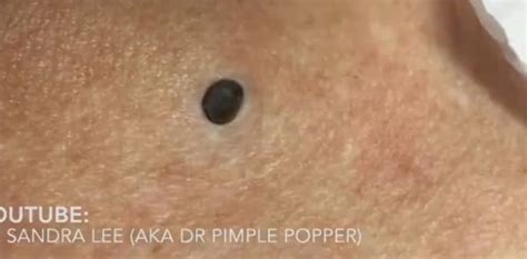 Dr Pimple Popper The Biggest Blackhead In History