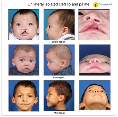 Cleft Lip And Palate Gallery Earwell Center Of Excellence
