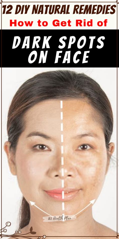 Use Colgate And Vaseline To Get Rid Of Dark Spots On The Face 17 How