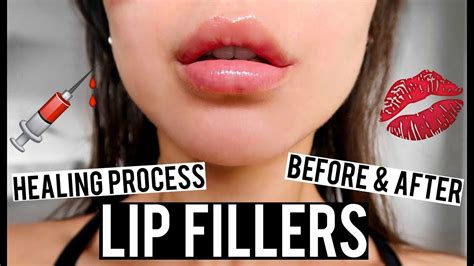 Lip Fillers Before And After And Healing Process Vlog