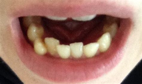 Bottom Tooth Pushed Back Child Dental Trauma Over The Last Three