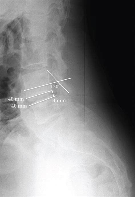 An Unusual Case Of Radicular Pain Caused By Bilateral Lumbar Synovial