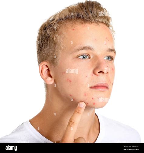 Teenage Boy With Acne Problem On White Background Stock Photo Alamy