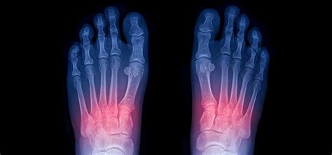 Lisfranc Injury Surgery Treatment And Recovery Time