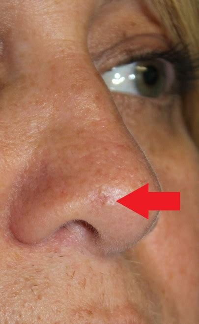 Skin Cancer Nose Skin Cancer