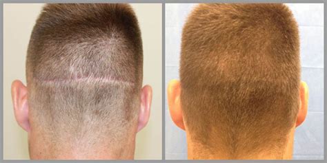 Questions To Ask Hair Transplant Surgeon Before Fue Hair Transplant