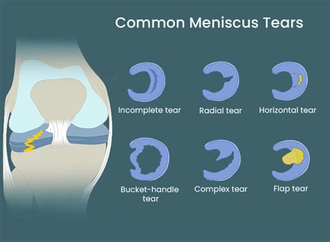 Meniscus Tear Specialists In Nj And Nyc The Spine And Rehab Group