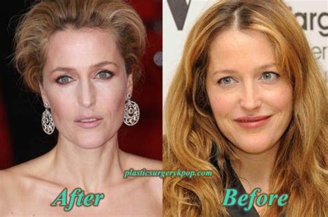 Gillian Anderson Plastic Surgery Nose Job Botox Before After Pictures