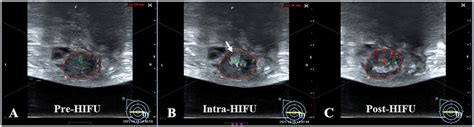 The Significant Gray Scale Changes During Hifu Treatment For Breast