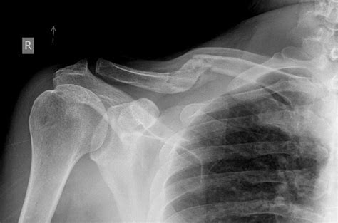 Operative Management Of Clavicular Malunion In Midshaft Clavicular
