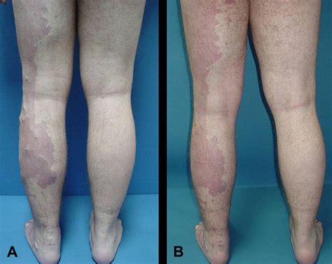 Diagnosis And Management Of Extensive Vascular Malformations Of The